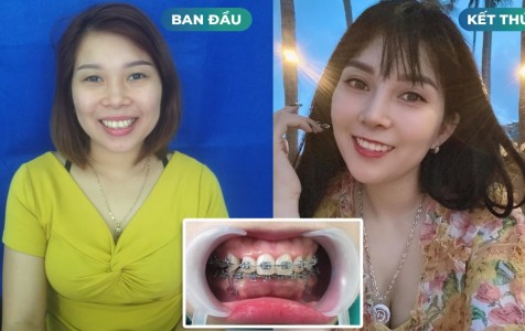 Bệnh nhân Dương Thị Lan Anh - Niềng răng mắc cài khắc phục tình trạng răng khấp khểnh