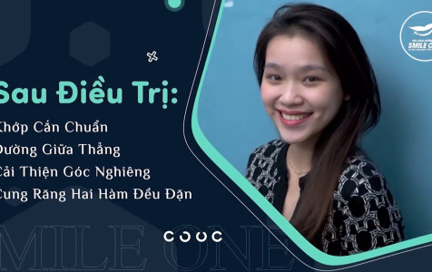 Hành trình thay đổi nụ cười cùng niềng răng Invisalign của cô sinh viên 9x