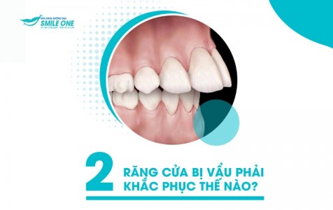 2 răng cửa bị vẩu phải khắc phục thế nào cho nhanh và hiệu quả? 