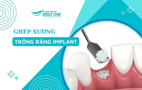 Ghép xương trong implant là gì và được thực hiện thế nào? 