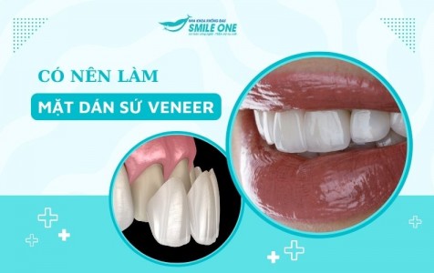 Có nên làm mặt dán sứ Veneer để có hàm răng trắng đều đẹp?
