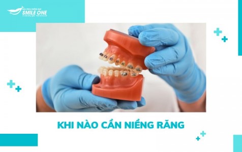 Khi nào cần niềng răng - Thời điểm nào niềng răng tốt nhất?