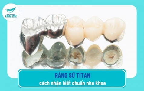 Cách nhận biết răng sứ Titan đúng, chuẩn theo nha khoa