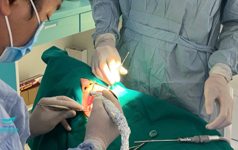 Chi Tiết Chia Sẻ Bác Sĩ v/v Cấy Ghép Implant Bao Lâu Thì Lành ?  