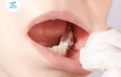 Chỉ tự tiêu nha khoa là gì? Tất cả những điều bạn cần biết