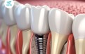 Nhiễm trùng implant: Nguyên nhân, dấu hiệu nhận biết khi mắc phải