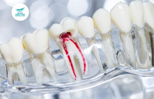 Triệu chứng sau khi lấy tuỷ răng: Bình thường & Bất thường