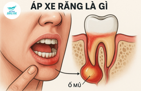 Áp xe răng là gì? Dấu hiệu nguy hiểm & tư vấn điều trị