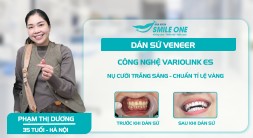 Phạm Thị Dương dán sứ Veneer không đau, không tiêm tê, không lấy tủy– Khắc phục răng ố  vàng bằng công nghệ dán sứ Variolink ES tại Smile One