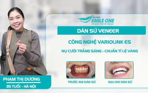 Phạm Thị Dương dán sứ Veneer không đau, không tiêm tê, không lấy tủy– Khắc phục răng ố  vàng bằng công nghệ dán sứ Variolink ES tại Smile One