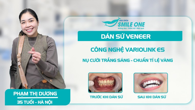 Phạm Thị Dương dán sứ Veneer không đau, không tiêm tê, không lấy tủy– Khắc phục răng ố  vàng bằng công nghệ dán sứ Variolink ES tại Smile One