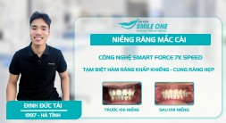 Khách hàng Đinh Đức Tài “Tạm Biệt” răng khấp khểnh và sâu vỡ với công nghệ niềng răng mắc cài Smart Force 7k Speed