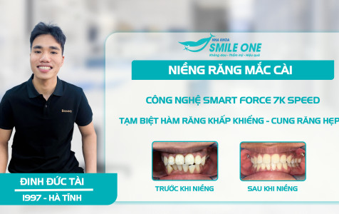 Khách hàng Đinh Đức Tài “Tạm Biệt” răng khấp khểnh và sâu vỡ với công nghệ niềng răng mắc cài Smart Force 7k Speed