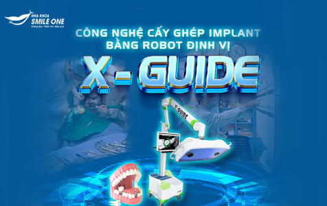 Ứng dụng Rô bốt định vị X Guide trong thăm khám và điều trị cấy ghép implant tại nha khoa Smile One