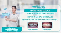 Hết hô thưa sau niềng răng và lời dặn của chuyên gia Việt Pháp 15 năm kinh nghiệm