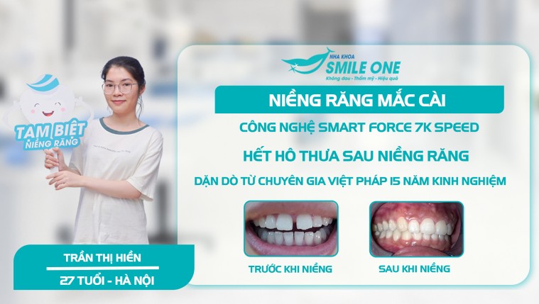 Hết hô thưa sau niềng răng và lời dặn của chuyên gia Việt Pháp 15 năm kinh nghiệm