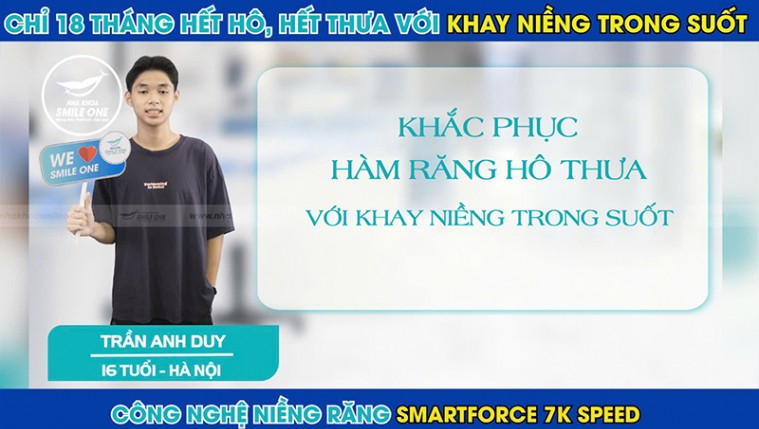 Chỉ 18 tháng Anh Duy đã khắc phục thành công răng hô với khay niềng trong suốt