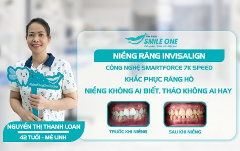 Tại sao chị Thanh Loan chọn niềng răng trong suốt? 