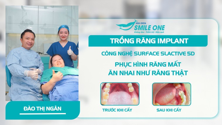 Đỉnh cao công nghệ cấy implant không rạch vạt lợi an toàn cho người cao huyết áp