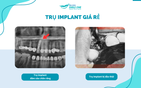 Ham trồng răng implant giá rẻ và những biến chứng khôn lường mà người bệnh phải đối mặt 