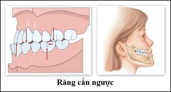 Khớp Cắn Ngược Răng Sữa: Nguyên Nhân, Tác Động Và Giải Pháp Toàn Diện