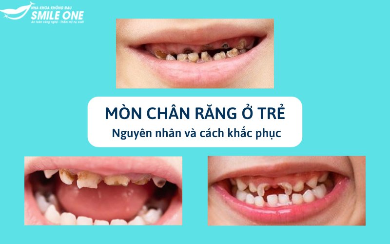 Bệnh ăn mòn chân răng ở trẻ em có thể được chữa trị như thế nào?
