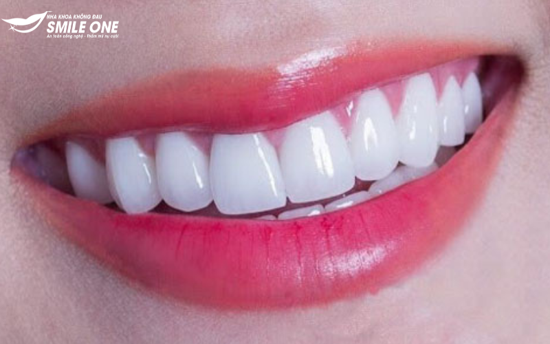 Top 5 dáng răng sứ được yêu thích nhất hiện nay