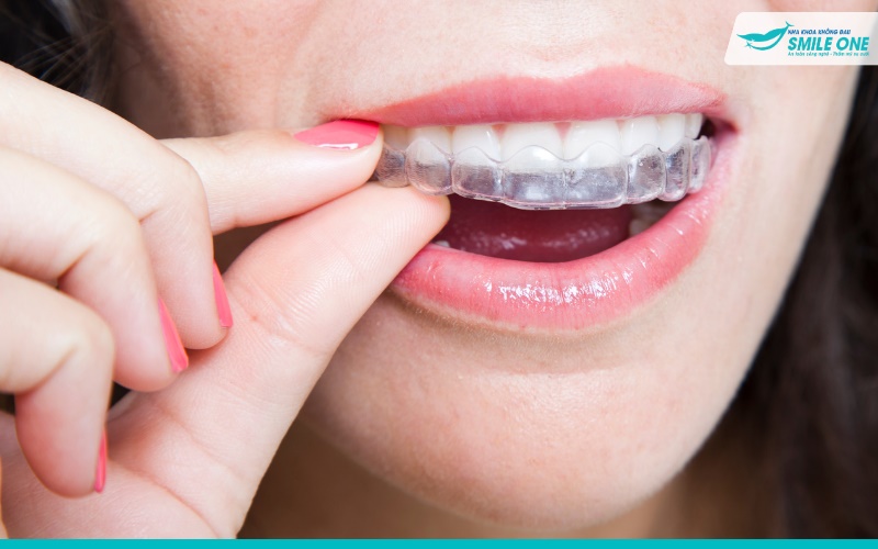 Các loại niềng răng trong suốt giúp chỉnh răng hiệu quả 1