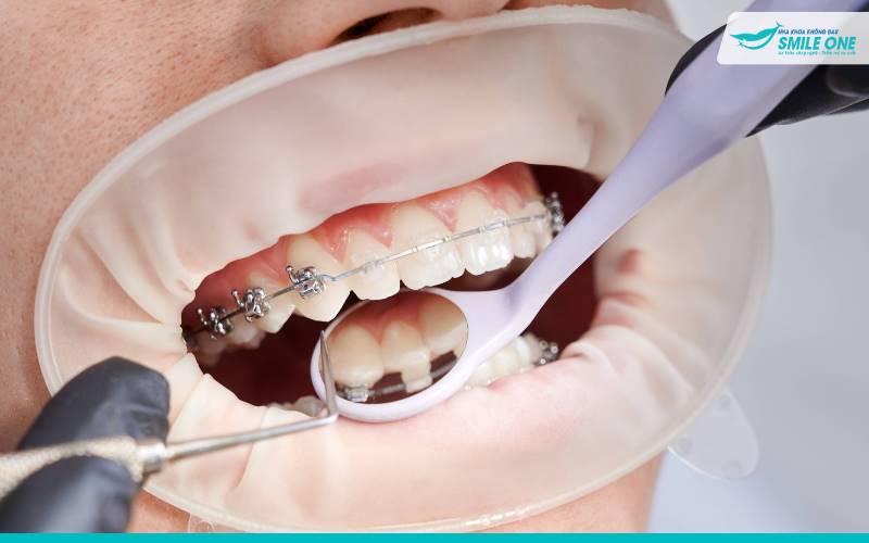 Giá niềng răng mắc cài sứ thường cao hơn so với mắc cài kim loại