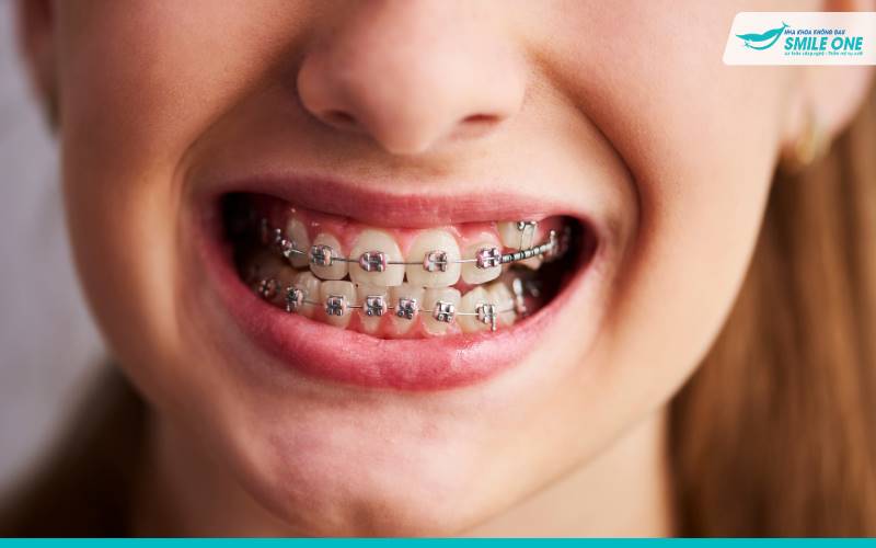 Giá niềng răng mắc cài mỗi loại sẽ khác nhau