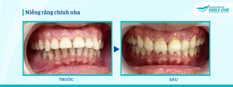 Các loại niềng răng trong suốt giúp chỉnh răng hiệu quả 9