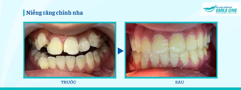 Các loại niềng răng trong suốt giúp chỉnh răng hiệu quả 8