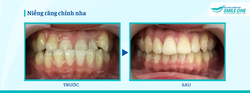 Các loại niềng răng trong suốt giúp chỉnh răng hiệu quả  7