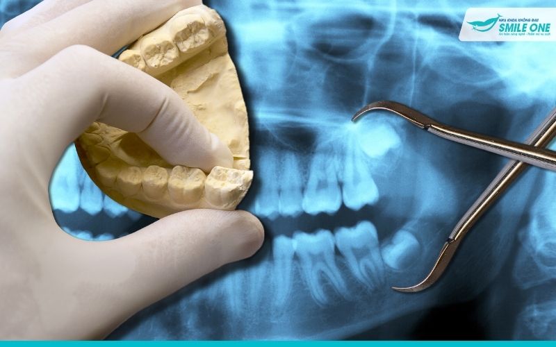 Nhổ răng khôn bị sâu – Nên nhổ hay điều trị thế nào 3