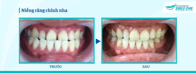 Niềng răng Invisalign - Công nghệ niềng răng trong suốt vượt trội 9