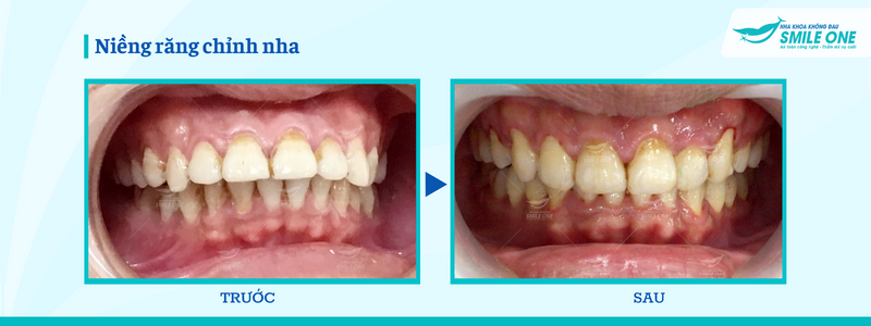Niềng răng Invisalign - Công nghệ niềng răng trong suốt vượt trội 8