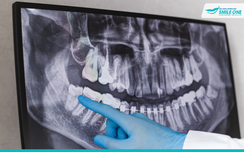 Nhổ răng khôn bị sâu – Nên nhổ hay điều trị thế nào 2
