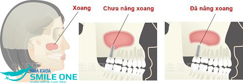 nang-xoang-trong-cay-ghep-implant-2
