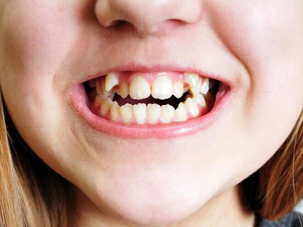 Răng mọc lệch ở trẻ và cách đề phòng