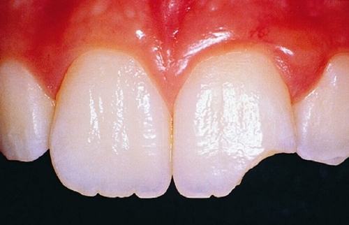 Răng như thế nào được gọi là mẻ