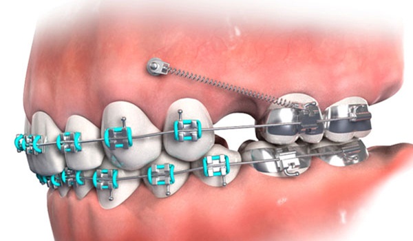 Quy trình niềng răng hô có tác động đến sức khỏe miệng và răng của bệnh nhân không?