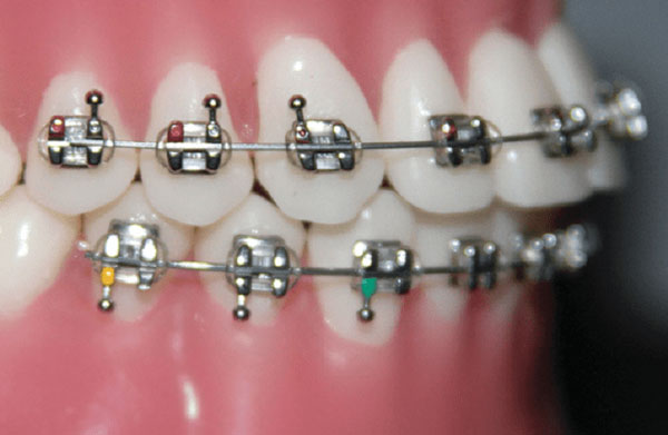 giá niềng răng mắc cài kim loại thường
