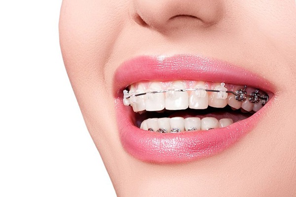 Phương pháp niềng răng 5 triệu khác gì so với niềng răng bằng Invisalign?
