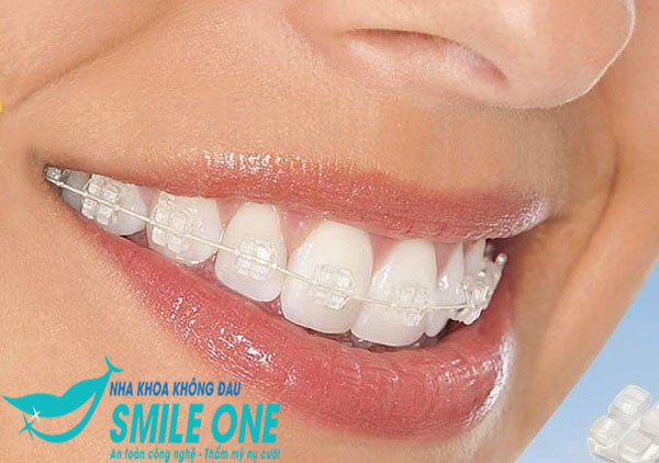 niềng răng mắc cài sứ 1 hàm