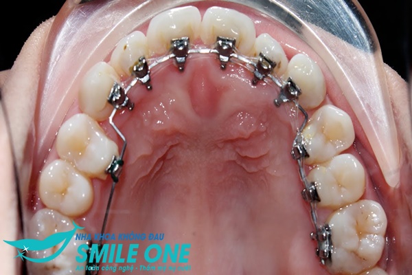 Có những rủi ro và tác động phụ nào khi niềng răng hàm dưới?
