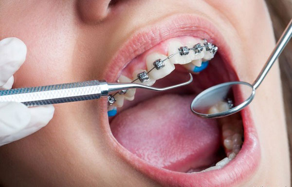 Lượm cao răng có đảm bảo hiệu quả trong việc chỉnh nha không?
