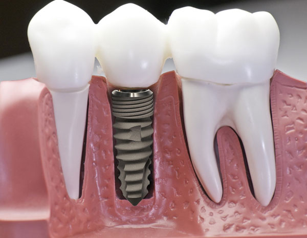 trồng răng có đau không và nên lựa chọn phương pháp nào