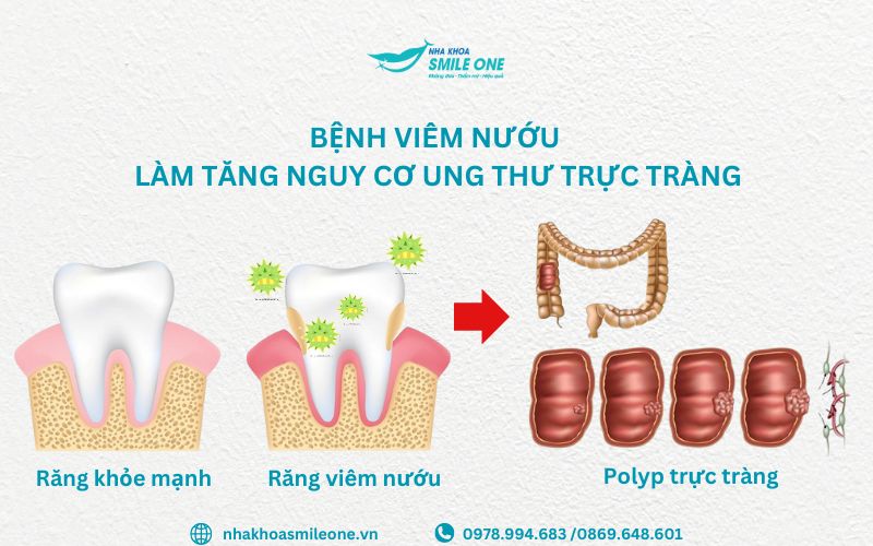 Bệnh viêm nướu răng có thể làm tăng nguy cơ ung thư đại trực tràng