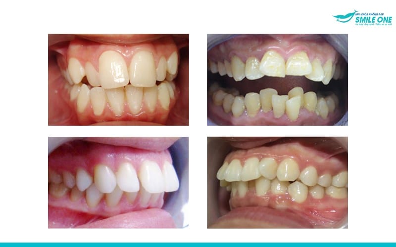 Một số dạng 2 răng cửa hoặc 4 răng cửa bị vẩu thường gặp
