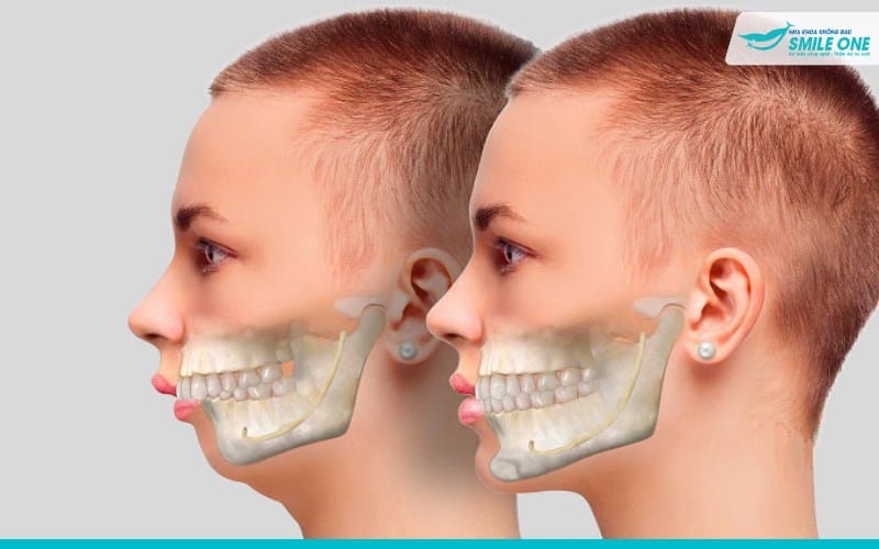2 răng cửa bị vẩu phải khắc phục sao cho nhanh và hiệu quả 1